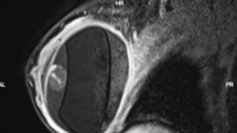 Nhiều phụ nữ gặp biến chứng nguy hiểm sau thời gian dài nâng ngực