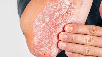Tự điều trị bệnh da, người đàn ông nằm cáng vì tổn thương khớp nghiêm trọng