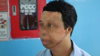 Chàng trai hóa “ngọn đuốc sống” vì hút thuốc khi đổ xăng, đi mổ hơn 20 lần