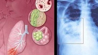 Chung tay phòng ngừa bệnh đường hô hấp do virus RSV gây ra