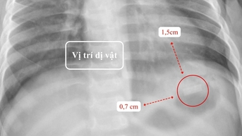 Bé 10 tháng suýt thủng ruột vì nuốt điếu thuốc lá chứa mảnh kim loại