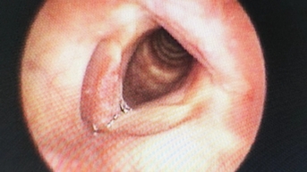 TPHCM: Phát hiện ca bệnh hiếm gặp, mắc cùng lúc 2 loại ung thư