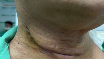 Đi khám vì khàn tiếng, phát hiện mắc 2 loại ung thư