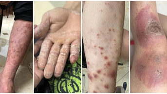 5 bệnh da liễu thường gặp trong mùa mưa lũ và cách xử lý