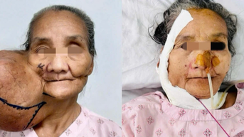 Diện mạo mới của người phụ nữ dân tộc thiểu số sau 40 năm mang khối u khổng lồ