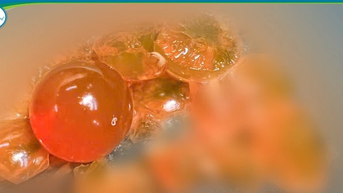 Bé trai 14 tháng tuổi bị tắc ruột vì nuốt hạt nở