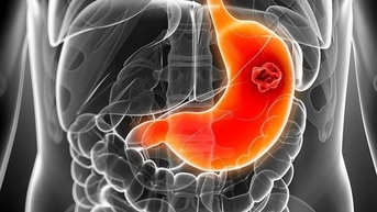 Bác sĩ chỉ cách ăn uống ngừa ung thư dạ dày