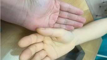 Mất lượng 3/4 lượng máu trong cơ thể vì chủ quan không loại bỏ u xơ tử cung