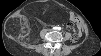 Bụng cụ bà to bất thường, căng tức, bác sĩ phẫu thuật lấy ra khối u ác tính gần 4kg
