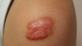 Các yếu tố nguy cơ gây sẹo lồi