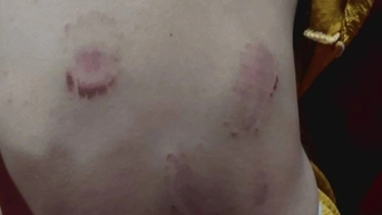 Bé gái 3 tuổi bị nhiều vết bầm tím, dấu răng trên người sau giờ học