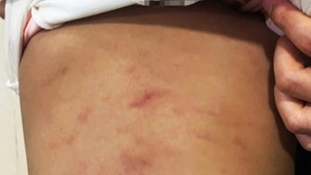 Bé gái 2 tuổi có dấu hiệu bị bạo hành ở nhóm trẻ tư thục