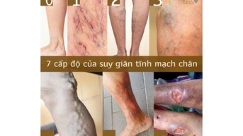 Phòng ngừa bệnh suy giãn tĩnh mạch