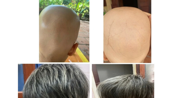 Điều trị thành công cho cháu bé 7 tuổi rụng tóc toàn thể bằng thuốc ức chế Janus kinase