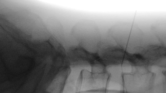 Dị vật 6cm “mắc kẹt” trong thắt lưng vì tự châm cứu