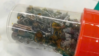 Mổ lấy hơn 100 viên sỏi trong túi mật nữ bệnh nhân