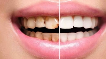 អត្ថប្រយោជន៍​នៃ​ការ​ធ្វើ​មាត្រដ្ឋាន​ធ្មេញ តើ​ពេលណា​ដែល​អ្នក​មិនគួរ​ធ្វើ​មាត្រដ្ឋាន​ធ្មេញ​?