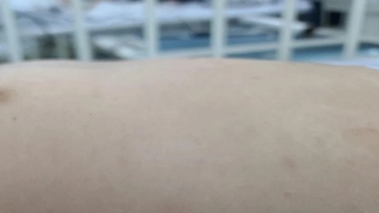 Cảnh báo về bệnh sốt mò dễ nhầm với cúm, có thể gây tổn thương gan, viêm màng não