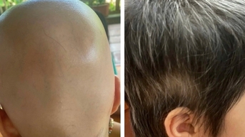 Nhiều người trẻ bỗng dưng rụng tóc trơ trọi