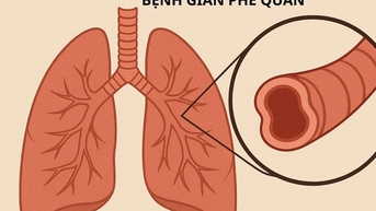 Ho ra máu cần cảnh giác với giãn phế quản