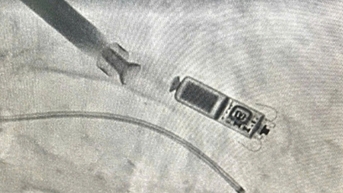 ឧបករណ៍​តូច​ទំហំ​ប៉ុន​កន្សោម​ជួយ​ស្ត្រី​អាយុ ៨៣ ឆ្នាំ​រួច​ផុត​ពី​ការ​ស្លាប់​ភ្លាមៗ