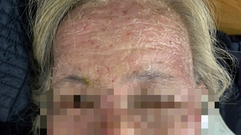 ដោយ​គិត​ថា​នាង​មាន​ដង្កូវ​នាង ស្ត្រី​នោះ​លេបថ្នាំ​ជក់​ខ្លួនឯង​ស្ទើរតែ​ស្លាប់ ។