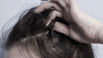 Thói quen thích nhổ tóc có thể là bệnh lý tâm thần?