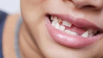 Vì sao con người có răng sữa và răng vĩnh viễn?