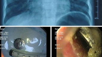 ក្មេងប្រុសម្នាក់នៅទីក្រុង Hai Phong បានទទួលរងនូវដំបៅបំពង់អាហារយ៉ាងធ្ងន់ធ្ងរ បន្ទាប់ពីបានលេបថ្មប៊ូតុង។