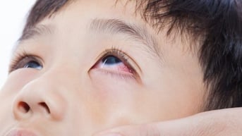 Trẻ nhiễm cúm, sởi, cha mẹ cần lưu ý thêm dấu hiệu này