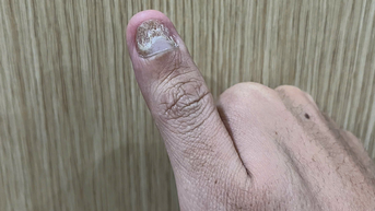 Trời nồm ẩm dễ mắc nấm da, nhận biết thế nào?