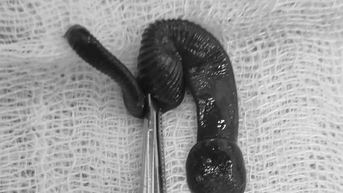 Người đàn ông 37 tuổi ở Nghệ An bị vắt dài 8cm sống trong mũi, thừa nhận một việc rất nhiều đàn ông hay làm
