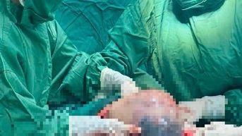 Bé trai 'đẻ bọc điều', 80.000 ca mới có một