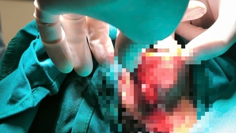 Bé trai 8 tuổi ở Hà Nội suýt mất vành tai do bị chó cắn