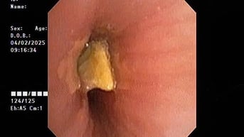 Bé trai 1 tuổi bị hóc hạt bí trong đường thở