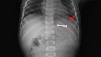 Gắp chiếc đinh vít dài 5 cm từ dạ dày trẻ 15 tháng tuổi