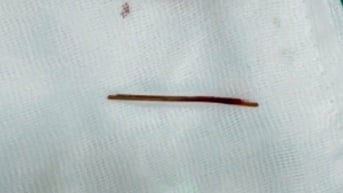 Phát hiện cây tăm dài 5 cm ghim trong gan bệnh nhân