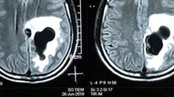 Méo miệng vì sán làm tổ trong não: Nguyên nhân từ món ăn khoái khẩu của người Việt