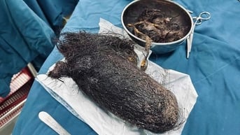 Lấy búi tóc khổng lồ nặng gần 1kg trong dạ dày bé gái 12 tuổi