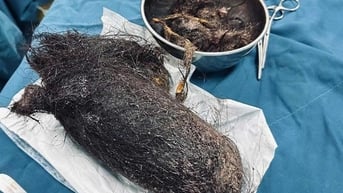 Búi tóc nặng gần 1kg nằm chắn ngang dạ dày bé gái 12 tuổi