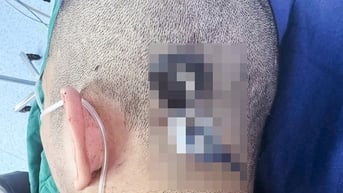 Nam sinh bị chìa khóa cắm sâu vào đầu gây chấn thương sọ não