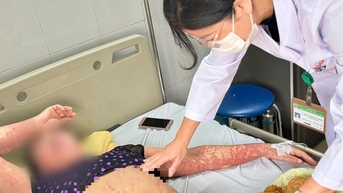 Người phụ nữ bị ngứa dữ dội, mặt sưng phù sau khi uống thuốc
