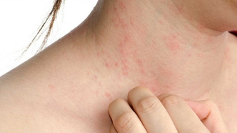 Bệnh nào dễ mắc trong mùa xuân?