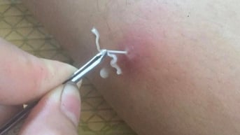 Bệnh giun rồng có nguy hiểm không?