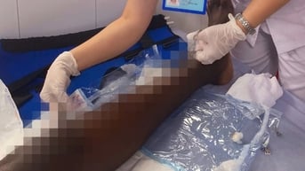 Phẫu thuật thành công cho người Nigeria bị gãy lún mâm chày nhập viện muộn 3 tuần