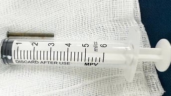 Bé trai 6 tuổi ở Quảng Ngãi thoát nguy hiểm nhờ được  gắp đinh sắt trong bụng
