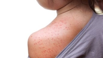 bệnh truyền nhiễm nguy hiểm vào mùa Đông Xuân