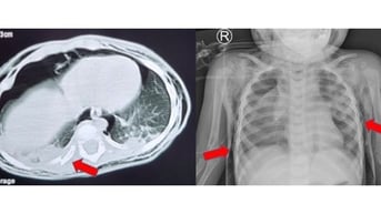 Ngã từ giường xuống đất, bé 1 tuổi bị vỡ khí quản
