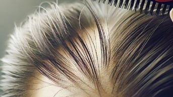 Vì sao căng thẳng lại gây rụng tóc?