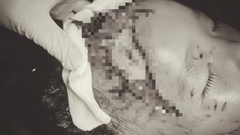 Bé trai 2 tuổi bị chó cắn lộ xương sọ khi sang nhà người thân chơi
